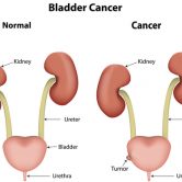 Study Claims That E-Cigarettes Could Cause Bladder Cancer