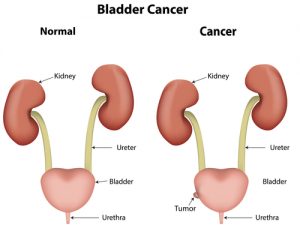 bladder-cancer-e-cigs